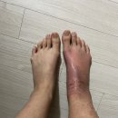 임주영피부과의원 | 병중일기 #6 - 통깁스 제거 피부 염증 폭발(재활 및 피부염)