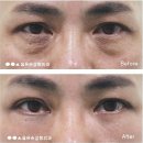 옳은손성형외과 하안검수술 만족도 높은 곳