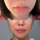 압구정 피부과 입술 필러+세르프 리프팅 3주차 ⭐️입술필러 왜이제했니 후회중인 내돈내산 찐후기)
