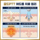 골드필 - 군포시 산본로323번길 16-25 | 골드PPT 3회차, 밀크필 스케일링 솔직 후기 내돈내산(feat. 성인 여드름)
