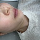 신촌옆들 | 신촌역피부과 텐써마 300샷 효과 고현정리프팅 후기