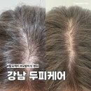 해피라인의원 | 강남 모발이식 잘하는 밴스모자이너의원 두피케어 후기