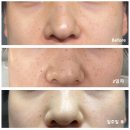 수성레이저 | 대구 수성구피부과 루비레이저 기미잡티 제거 내돈내산 후기