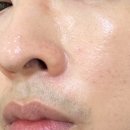 제이씨메디칼 | 메디컬오 모공리액터 10회 받아본 후기, 가격