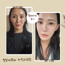 (주)아주 카페테리아 | 청담피부과 라인리프팅 , 1회부터 확달라진 엠페이스 솔직 후기!