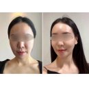 청담셀의원 | NP리쥬란| 무통리쥬란으로 물광피부만들기| 안아픈 리쥬란 대만족 후기🩵