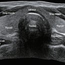 갑상선 초음파 검사[thyroid ultrasonography] 이미지
