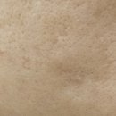 보조개한의원 | 대구 여드름 패인 흉터 한의원 새살침 총 1~13회차 치료 후기