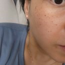 효성의원 | 경산 효성의원 레이저 후기 ㅣ 동네 피부과 출산 후 기미, 주근깨 당근 핫플 광고인가 아닌가 확인하러...