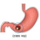 진행된 위암(Advanced gastric cancer) 이미지