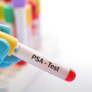 전립선암 치료 후 PSA 수치 상승의 의미 이미지