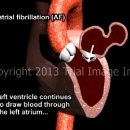 Ch 42 Supraventricular Tachycardia 이미지