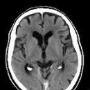 척수공동증(Syringomyelia) 이미지