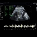 미즈웰산부인과의원 | 더미즈웰산부인과 임당검사 후기