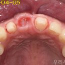 뿌리내린치과의원 | 길어 보이는 앞니 임플란트 크라운, 잇몸 이식과 브릿지로 심미성 회복한 증례