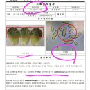 병증 시료 검사 탄저병 이미지