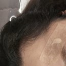 울산] 예쁨주의쁨의원에서 인중제모 겨드랑이제모레이져 점,쥐젖제거후기 (+주의사항)