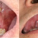 혹시 이게 구강암?... '2주 이상 구내염+혀 반점' 확인! 이미지