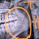 이화그린약국 | 사랑이아프니 홍대점 매복 사랑니 발치 후기