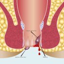 예항맥외과 | 원주치질? 교수 출신 의사가 알려주는 통증 최소화 치료법