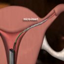 ESSURE 관련 논문 모음 이미지