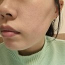 멍스터 | [여의도피부과]콜라스터포텐자후기 +주의사항, 멍, 붓기