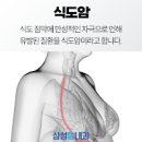 식도암 증상 1기 초기증상 과 예방 뜨거운음식 주의 이미지