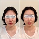 코리아엔제이 | 대구피부관리 제이라인코리아 올리푸 에어젯 리프팅 후기