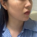 예뻐진의원 | 청담동 에이든의원 턱끝필러 자연스럽게 예뻐진 후기