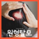 청평연세의원 | 춘천온의동피부과 원형탈모 머리카락이 동그랗게 빠져요