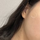 오아로피부과의원 | 강동 오아로피부과 흑자 제거 내돈내산 대만족 후기✨