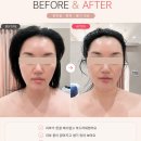 피부관리, 신풍역 오블리&숲칼프, 시바산 발삼 케어...완성하는 무통증 진피층 수분 폭탄 솔직 후기