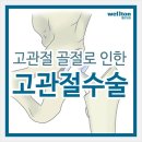 고관절,고관절인공관절 ,인공관절수술잘하는곳 이미지