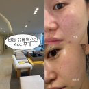 멍케어존 | 명동피부과 스킨보톡스 추천 : 쥬베룩스킨 4cc 내돈내산 후기 (통증, 가격, 엠보, 멍, 효과)