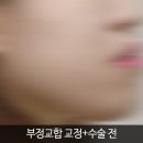 미서울성형외과 네이버블로그