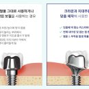 덴티움기공소 네이버블로그