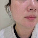 마산 | 얼굴 꺼짐과 탄력 고민 창원피부과 스컬트라 마산피부과 후기