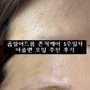 도아메디 | 아줄렌 오일 추천 좁쌀여드름 없애고 흔적케어하는 법 아크핏 비상 베타-G 아줄렌 포커스 오일