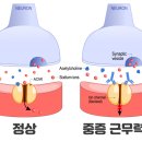 쌍꺼풀을 시작으로 전신 근육이 풀렸다! ‘중증 근무력증’ 의심 증상 & 치료 이미지