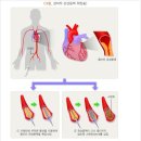 좌관상동맥(LCA)[ LIX 좌회선지와 LAD 좌전하행지] 이미지