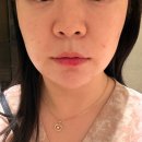 대치건강식품 | 대치역 피부과 볼패임 시술 티타늄리프팅 쥬베룩볼륨 만족 후기 조합