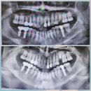 다빈치한의원 | 고속터미널역 안면 비대칭 얼굴 교정 한의원 26회차 유지력 및 가격 치료 방법 후기