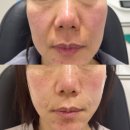 르쏘메의원 | 청담피부과 르쏘메의원 팔자주름 실리프팅 + 콜라겐주사 시술전후 효과