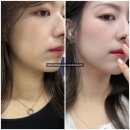 반니성형외과의원 | 반니성형외과 쥬베룩 후기 리쥬란 쥬베란 스킨 부스터