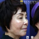 리뉴미피부과의원 네이버블로그