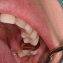 해드림치과의원 | 어금니 크라운 뜯고보니 그냥 빼자고 할걸 그랬나봐 재신경치료 어금니살리