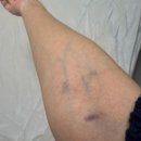 176 | 임당재검 후기｜1차 176 나왔는데 재검사 통과했어요 (원인 정리)