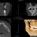 리볼리치과의원 | 오리역 치과 추천｜리볼리치과 임플란트 후기 (진짜 믿고 맡길 수 있었던 이유…)