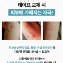 예민피부&amp;아기도 사용가능한 의료용 실리콘 테이프 &#34;이노테이프&#34; 후기