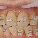 이바르게치과의원 | 전주 이바르게치과 토끼이빨 교정후기